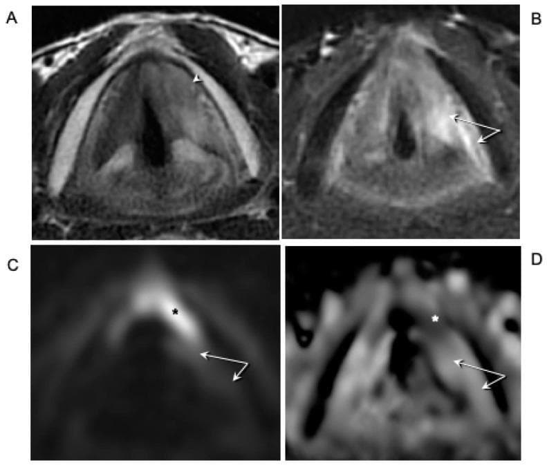 This composite diagnostic image displays axial MRI sequences of the larynx in a patient with recurrent glottic squamous cell carcinoma. Panel (A) is a T2-weighted axial image showing intermediate signal intensity neoplastic tissue in the anterior third of the left true vocal cord, extending across the anterior commissure and invading the left inferior paraglottic space (white arrowhead). Panel (B) utilizes T2-weighted imaging with fat suppression to highlight hyperintense signal alterations (white arrows) in the posterior aspect of the left vocal cord and posterior paraglottic space, indicative of peritumoral edema rather than tumor infiltration. Panels (C) and (D) show Diffusion-Weighted Imaging (DWI) and the corresponding Apparent Diffusion Coefficient (ADC) map, respectively. The tumor demonstrates restricted diffusion characterized by hyperintensity on DWI (black asterisk) and hypointensity on the ADC map (white asterisk). The absence of restricted diffusion in the posterior larynx (white arrows in C and D) confirms the edematous nature of those signal changes, supporting the clinical determination of a tumor-free posterior paraglottic space despite fixed vocal cord mobility.