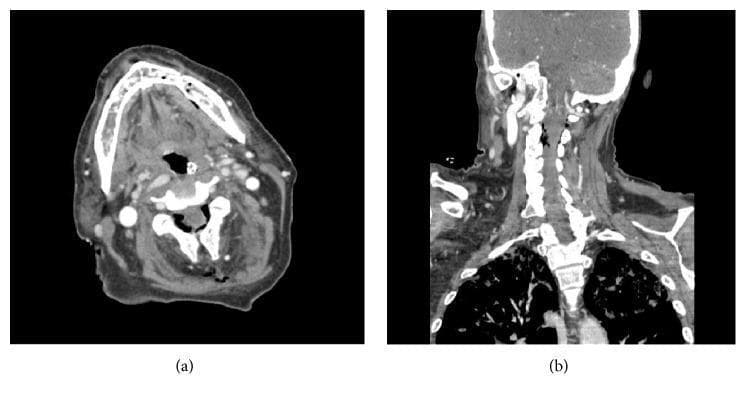 This diagnostic image consists of two Computed Tomography (CT) scans highlighting complications related to maxillofacial and cervical infection. Figure (a) is an axial CT scan at the level of the mandible. It demonstrates the absence of discrete fluid collections or abscesses in the soft tissues, but reveals pathological air within the medullary marrow space of the left posterior mandible, suggesting osteomyelitis with gas-forming organisms or communication with a necrotic track. Figure (b) is a coronal CT reconstruction of the neck and upper thorax. It visualizes the cervical spine, paraspinal soft tissues, and superior mediastinum/lung apices. The significant clinical finding is pneumorrhachis, characterized by the presence of air within the epidural space of the cervical spinal canal. These findings are clinically significant in the context of necrotizing infections, sepsis, and potential spread of air/infection from the oral cavity into deep cervical and spinal spaces.