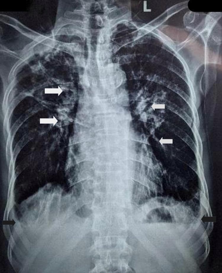 This diagnostic image is a posteroanterior (PA) chest X-ray of an adult male, demonstrating multiple pulmonary and mediastinal abnormalities. Key findings include bilateral patchy ground-glass opacities, multiple scattered nodules, and evidence of small cavitary lesions located in the right upper and left lower lobes. Prominent calcified mediastinal and hilar lymphadenopathy is identified by white arrows, suggestive of chronic granulomatous disease such as tuberculosis. In the lower thoracic region, mild bilateral pleural effusions are evidenced by the blunting of the costophrenic angles, indicated by black arrows. The image also displays features consistent with chronic obstructive pulmonary disease (COPD), including hyperinflated lung fields. This radiograph serves as a clinical example of pulmonary tuberculosis sequelae and superimposed acute pneumonitis in a patient with pre-existing obstructive lung disease.
