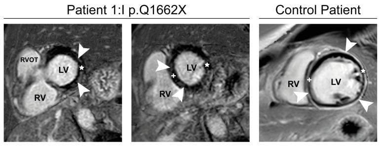Diagnostic cardiac MRI scans utilizing Phase-sensitive inversion-recovery (PSIR) sequences to demonstrate late gadolinium enhancement (LGE) patterns in FLNC-cardiomyopathy. The image comprises three short-axis views: a basal view (left) and mid-ventricular view (center) of Patient I:1 (p.Q1662X), and a comparison view of a control patient (right). In the Patient I:1 images, white arrowheads indicate focal subepicardial to mid-wall late enhancement localized within the lateral wall (indicated by a star) and the interventricular septum (indicated by a plus sign). Structural landmarks include the left ventricle (LV), right ventricle (RV), and right ventricular outflow tract (RVOT). In contrast, the control patient (right) shows more diffuse, extensive late enhancement throughout the myocardium, involving larger portions of the left ventricular circumference. This imaging modality and pattern are used to identify myocardial fibrosis or replacement, which is a hallmark finding in filamin-C (FLNC) related cardiomyopathies and differentiates it from standard ischemic patterns.
