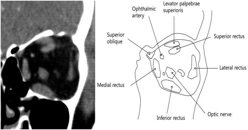 This composite educational graphic features a contrast-enhanced computerized tomography (CT) scan and a corresponding anatomical schematic of the left orbit in the coronal plane. The CT image displays the soft tissue window, highlighting the retrobulbar space and extraocular muscles (EOM) within the orbital fat. The accompanying diagram provides labeled identification of the orbital contents, including the superior rectus, inferior rectus, medial rectus, and lateral rectus muscles. Additionally, the schematic delineates the superior oblique, levator palpebrae superioris, ophthalmic artery, and the central optic nerve. The visual focus is on the cross-sectional morphology of the EOMs, particularly demonstrating a larger cross-sectional area of the inferior rectus compared to the superior rectus. This comparison is relevant for assessing Thyroid Eye Disease (TED) or other orbital pathologies involving muscle hypertrophy. The material is designed for intermediate to advanced medical education, specifically within ophthalmology and radiology, to teach orbital anatomy and the diagnostic interpretation of CT scans for muscle-sparing or involvement patterns.