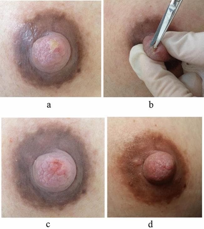A series of four clinical photographs (a-d) documenting the management and healing of a chronic nipple injury in a breastfeeding patient. Image (a) shows the initial presentation of the nipple with visible white-matter keratinization and necrotic plaque on the superior surface, accompanied by hyperpigmentation of the areola. Image (b) captures the intraoperative debridement procedure where a clinician, using sterile technique, employs ophthalmic scissors to excise the keratinized necrotic tissue. Image (c) shows the immediate post-debridement state, revealing fresh, pink underlying tissue with the necrotic layer successfully removed. Image (d) illustrates the clinical outcome five days post-intervention, showing a completely healed nipple surface with resolved inflammation and restoration of normal tissue texture. This series demonstrates the effectiveness of mechanical debridement in treating breastfeeding-related nipple trauma and secondary hyperkeratosis to facilitate wound healing and pain relief.