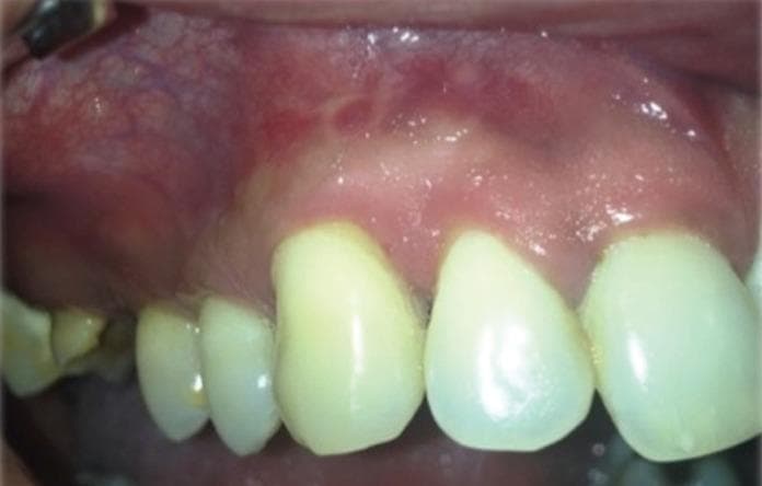 This clinical photograph displays an intraoral view of the maxillary gingiva and oral mucosa following chemotherapy for plasmablastic lymphoma. The image serves as a post-treatment control, demonstrating the resolution of previously documented violaceous, ulcerated masses. The alveolar mucosa appears healthy and pink with normal vascularity and a smooth texture, showing no evidence of residual tumor or recurrent lesions. The attached gingiva maintains a firm appearance with a well-defined gingival margin, though slight recession is visible in the interproximal spaces. The visible maxillary teeth show uniform yellowish-white coloration and mild physiological wear on the incisal edges. This visual is significant for medical education in oncology and oral medicine, illustrating the appearance of clinical remission in the oral cavity after systemic treatment for aggressive hematologic malignancies.
