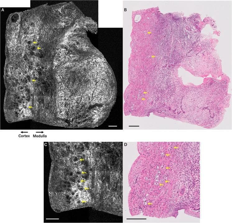 A comparison of human ovarian tissue imaging using two different modalities: Optical Coherence Tomography (OCT) and Hematoxylin and Eosin (H&E) histology. Panel A (OCT) and Panel B (H&E) show low-magnification cross-sections of the ovary, clearly demarcating the outer cortex and inner medulla. In the OCT images (A, C), primordial and primary follicles appear as small, dark, rounded signal-void structures embedded within the hyper-reflective, fibrous ovarian stroma. Panels C and D provide magnified views of these structures. Yellow arrows highlight the direct correlation between the dark circular features in the grayscale OCT images and the corresponding microscopic follicles in the pink/purple H&E-stained sections. This comparison illustrates OCT's utility in non-invasive, real-time assessment of ovarian reserve by visualizing follicle distribution and density within the cortical layer. The scale bars represent 200 micrometers. This material is targeted toward intermediate to advanced medical education in gynecology, reproductive endocrinology, and diagnostic imaging.