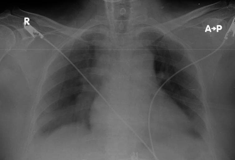 This diagnostic image is an anteroposterior (AP) chest X-ray of an adult patient, as indicated by the 'A-P' and 'R' (right side) labels. The radiograph demonstrates bilateral increased opacities with a lobar distribution, particularly prominent in the lower lung zones, consistent with consolidation seen in community-acquired pneumonia. The pulmonary vasculature appears congested, and there is a mild blurring of the cardiac borders. Several medical monitoring devices are visible: electrocardiogram (ECG) leads and wires are seen crossing the chest field, entering near the clavicular regions and extending toward the lower torso. The trachea is midline, and the osseous structures including the ribs and clavicles appear intact. This imaging is used to illustrate the radiographic presentation of lobar pneumonia and the presence of typical clinical monitoring equipment in a preoperative or intensive care setting.