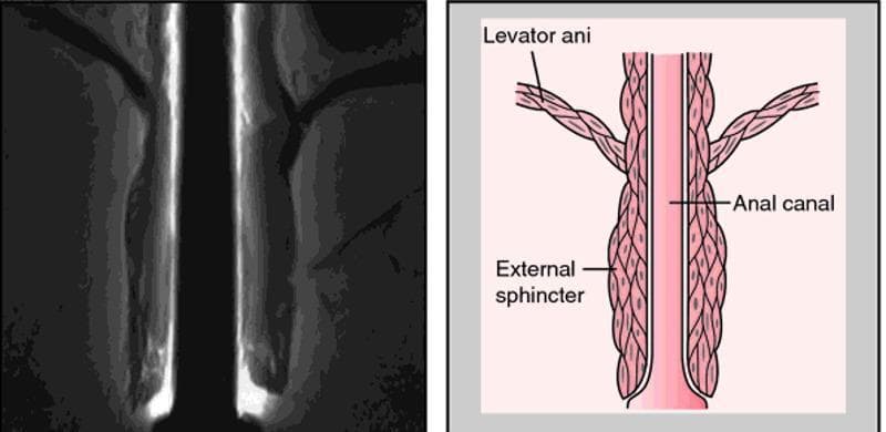 A composite image for medical education comprising a diagnostic radiological image (MRI) on the left and a corresponding anatomical diagram on the right, illustrating the pelvic floor and anal canal. The MRI shows a coronal view of the anorectal region, highlighting the muscular layers of the pelvic outlet. The anatomical diagram provides a schematic representation of the same structures for clarity. It labels the levator ani as a broad, striated muscle group superiorly that forms the pelvic diaphragm and descends to blend with the longitudinal muscle layer of the anal canal. The external sphincter is depicted as a distinct, thicker muscular cuff surrounding the distal portion of the anal canal, located inferior to the levator ani's main attachment points. This visual comparison is designed to teach the spatial relationships between the pelvic floor muscles and the terminal digestive tract, emphasizing the functional anatomy required for fecal continence. The educational focus is on identifying the levator ani and external sphincter during pelvic imaging and understanding their relative morphology.