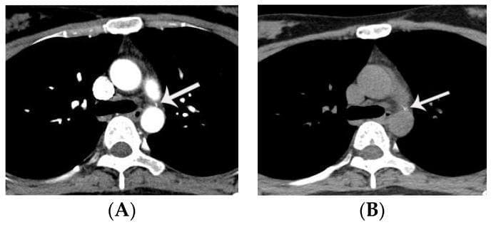 This diagnostic image consists of two axial chest CT scans—contrast-enhanced (A) and non-contrast (B)—demonstrating a calcified ligamentum arteriosum in a 32-year-old female. Both images show a small, well-defined, hyperdense focal point (indicated by white arrows) located at the level of the tracheal bifurcation. This calcification is positioned within the aortopulmonary window, specifically near the 12 o'clock position relative to the descending thoracic aorta. Anatomical landmarks include the descending thoracic aorta posteriorly, the bifurcation of the trachea (carina) centrally, and the pulmonary artery adjacent to the aorta. The primary educational focus is to distinguish this benign, physiological calcification of the ligamentum arteriosum from a small patent ductus arteriosus (PDA). On enhanced CT (A), the high density of the calcification can mimic vascular enhancement; however, the non-contrast image (B) confirms the pre-existing high density characteristic of calcification rather than contrast-filled lumen. This distinction is critical for radiologists to avoid misdiagnosing a congenital vascular shunt.