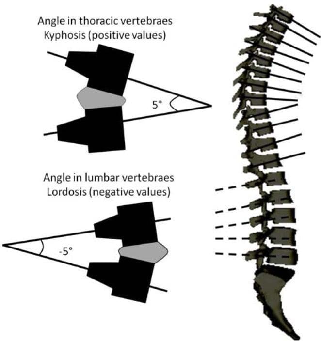 This medical schematic illustrates the sagittal spinal curvatures and the mathematical methodology for calculating vertebral angles using a device like the Spinal Mouse. The image features a lateral view of a human spinal column showing the physiological curves. To the left, two detailed diagrams demonstrate the angular calculation for different spinal regions. The top diagram shows the thoracic vertebrae, where a convex posterior curve is defined as kyphosis; this is represented by positive angular values (exemplified by a +5° angle formed by lines extending from the vertebral bodies). The bottom diagram shows the lumbar vertebrae, where a concave posterior curve is defined as lordosis; this is represented by negative angular values (exemplified by a -5° angle). This visual aid is intended for orthopedic and physiotherapeutic education to explain how digital spinal analysis tools quantify postural alignment and sagittal balance. Key anatomical landmarks included are the thoracic and lumbar vertebral bodies and the sacrum.
