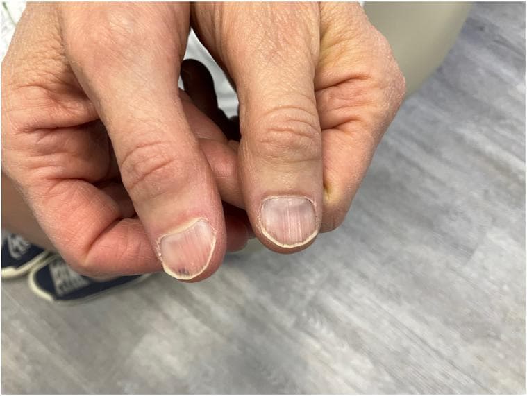 This clinical photograph displays the dorsal view of two thumbs, showcasing the nail plates. The primary finding is the presence of multiple longitudinal splinter hemorrhages. These appear as thin, reddish-brown to dark-maroon linear streaks located within the nail bed, oriented parallel to the long axis of the nail. The hemorrhages are most prominent on the distal portion of the nail plates. On one thumb, a small, more localized dark-purple subungual spot is visible near the distal edge. The surrounding periungual skin, including the proximal and lateral nail folds, appears normal without signs of inflammation, paronychia, or splintering. The nail surface is smooth, and there is no evidence of onycholysis (separation of the nail plate from the bed). Such findings are clinically significant as they can be associated with localized trauma, systemic diseases like infective endocarditis, or drug-induced reactions (e.g., nitrofurantoin). This image serves as a reference for dermatology and internal medicine residents to identify classic splinter hemorrhage morphology.