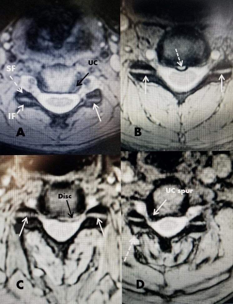 This set of four axial magnetic resonance imaging (MRI) scans demonstrates the normal anatomy and various degenerative pathologies of the cervical spine, with a focus on the facet and uncovertebral joints. Panel A displays normal anatomy, labeling the superior facet (SF), inferior facet (IF), and uncovertebral (UC) joint located lateral to the intervertebral disc. Panel B identifies a midline annular tear, visible as a small hyperintensity at the posterior disc margin. Panel C shows a disc herniation protruding into the ventral spinal canal. Panel D illustrates advanced degenerative changes, specifically a large osteophyte or 'UC spur' originating from the uncovertebral joint and projecting into the intervertebral foramen, alongside mild enlargement of the adjacent facet capsule. These images collectively serve as an educational resource for identifying key cervical structures and understanding how disc herniations, annular tears, and osteophytosis impact the spinal canal and neural foramina in relation to the stable horizontal orientation of the cervical facet joints.