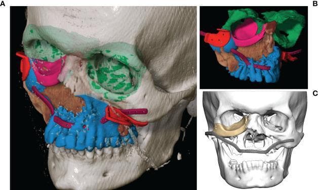 Educational diagnostic and 3D modeling image illustrating computer-assisted surgery (CAS) planning for a complex midfacial reconstruction following Ewing’s sarcoma resection. Figures A and B demonstrate virtual segmentation and surgical planning through a color-coded schema: the segmented primary tumor is shown in brown, while the planned bony resection margins are in blue. Red markers indicate the surgical cutting guides. For reconstruction, the unaffected left orbit (green) is mirrored to guide the restoration of the right orbital floor using a patient-specific PEEK implant (pink). A purple segment outlines the virtual design for a titanium maxillary reconstruction plate. Figure C presents a grayscale 3D skull model highlighting the finalized patient-specific implants (PSIs) in gold, including the orbital floor component and a large-span midfacial reconstruction plate. The image serves as a detailed example of CAD/CAM technology in oral and maxillofacial surgery, focusing on anatomical mirroring, tumor mapping, and the integration of patient-specific implants to restore both functional and aesthetic facial contours.
