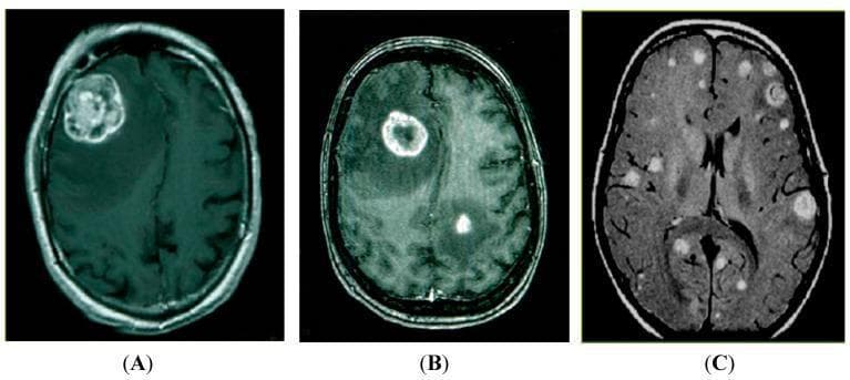 This diagnostic image consists of three axial Magnetic Resonance Imaging (MRI) scans of the human brain demonstrating varying patterns of intracranial metastasis, likely derived from lung cancer. Panel (A) shows a solitary metastasis: a large, heterogeneous, lobulated mass in the right hemisphere with significant mass effect and surrounding vasogenic edema. Panel (B) illustrates oligometastatic disease, featuring two distinct lesions; the larger anterior lesion exhibits classic peripheral ring enhancement and significant internal necrosis or cystic change, typical of rapidly growing metastatic tumors. Panel (C) displays multiple brain metastases, characterized by numerous hyperintense, smaller lesions of varying sizes disseminated throughout the parenchyma in both hemispheres. These images serve to categorize metastatic progression into solitary, oligometastatic, and multiple lesion stages, which is critical for determining neurosurgical versus radiotherapeutic treatment strategies. The modality highlights the role of contrast-enhanced MRI in identifying the breakdown of the blood-brain barrier associated with secondary CNS malignancies.