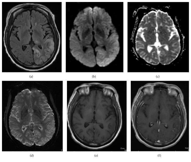 This diagnostic multi-sequence MRI of the brain illustrates a 6-panel series (a-f) used to evaluate subacute neurological changes, specifically GAD65-antibody associated autoimmune encephalitis. The axial FLAIR image (a) demonstrates hyperintense signal and gyriform swelling within the cortex and subcortical white matter of the left parieto-occipital lobe, with an additional hyperintense focus in the left thalamus. Corresponding Diffusion-Weighted Imaging (b) and Apparent Diffusion Coefficient (c) maps reveal mild restricted diffusivity in the affected cortical regions, suggesting cytotoxic edema. The susceptibility-weighted image (d) shows no evidence of hemorrhage or mineral deposition. Pre-contrast (e) and post-gadolinium T1-weighted (f) images show no significant mass effect or pathological enhancement, differentiating this inflammatory/autoimmune process from neoplastic or acute infectious etiologies. This imaging profile is characteristic of autoimmune encephalitides, where cortical signal changes occur without significant contrast enhancement or acute hemorrhagic transformation.