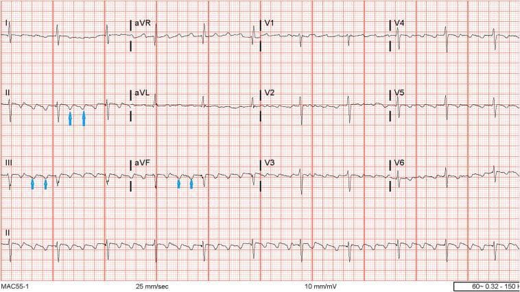 A standard 12-lead electrocardiogram (ECG) displayed on a traditional grid background (25 mm/sec, 10 mm/mV). The tracing demonstrates typical Atrial Flutter (AFL). The most prominent feature is the continuous 'sawtooth' baseline pattern, consisting of rapid, regular flutter waves (F waves). These F waves are most clearly visualized in the inferior leads (II, III, and aVF), where they exhibit a predominantly negative deflection. Blue arrows in leads II, III, and aVF highlight these recurring macro-reentrant atrial oscillations. The ventricular rhythm is regular, suggesting a fixed atrioventricular (AV) conduction ratio, likely 2:1 or 4:1 given the flutter rate. Normal QRS complexes and T waves are present across all leads but are superimposed upon the undulating flutter baseline. Precordial leads (V1-V6) show small, upright flutter waves in V1, typical for counterclockwise cavotricuspid isthmus-dependent atrial flutter. This diagnostic image serves as a classic educational example for identifying supraventricular tachyarrhythmias and understanding the morphology of counterclockwise atrial flutter.