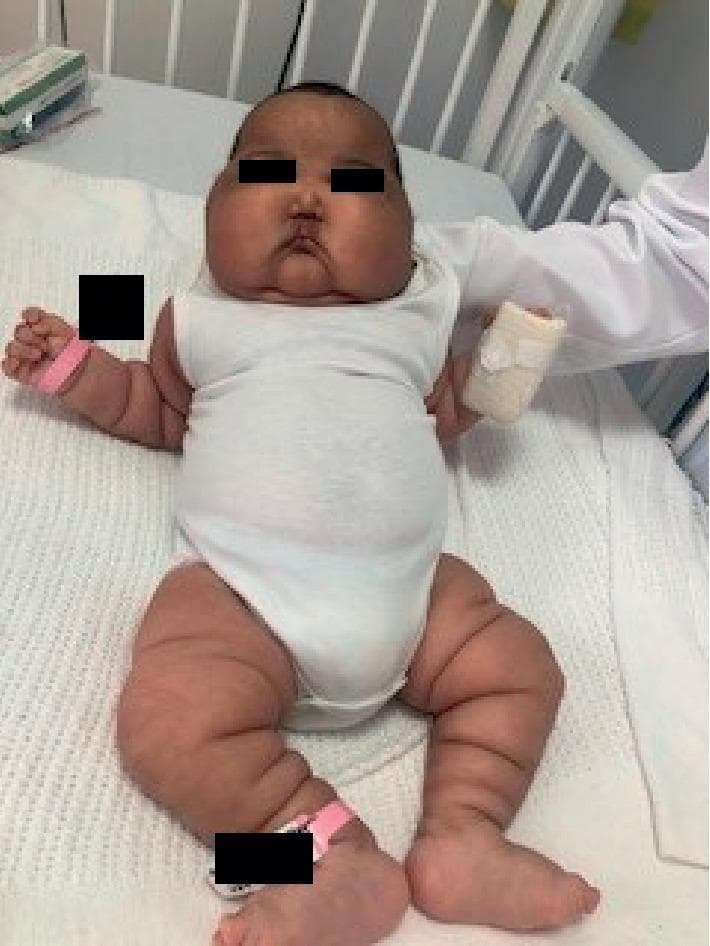This clinical photograph displays an infant in a supine position, demonstrating generalized edema (anasarca) and features suggestive of Cushingoid facies. The patient exhibits significant facial puffiness with full, rounded cheeks and obscured facial contours, characteristic of 'moon facies.' There is evidence of generalized swelling throughout the upper and lower extremities, with visible skin distention and increased circumference of the limbs. The skin appears taut and smooth over the edematous areas. Clinical markers of a medical setting are present, including pink identification bands on the right wrist and ankle, and a white bandage on the left hand. The image serves as an educational illustration of systemic fluid retention and physical manifestations of hypercortisolism in a pediatric patient, likely in the context of iatrogenic Cushing syndrome. The infant is shown on a hospital bed, and the photograph is focused on the morphology and distribution of the edema across the entire body.