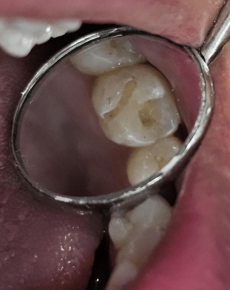 This clinical intraoral photograph, captured via a dental mirror, shows a Class I cavity preparation on the occlusal surface of tooth 26 (maxillary left first molar). The cavity preparation is centrally located and follows the anatomy of the pits and fissures, displaying an irregular morphology characteristic of conservative caries excavation. The internal walls of the preparation appear smooth and well-defined, with the pulpal floor exhibiting a darker, matte yellowish-brown appearance compared to the surrounding translucent white enamel, indicating exposed dentin. The marginal ridges remain intact, preserving the structural integrity of the tooth. The image serves as an educational example of operative dentistry, specifically the initial stages of a restorative procedure for occlusal caries before the application of bonding agents or composite resin. Surrounding soft tissues, including the buccal mucosa, are visible in the periphery.