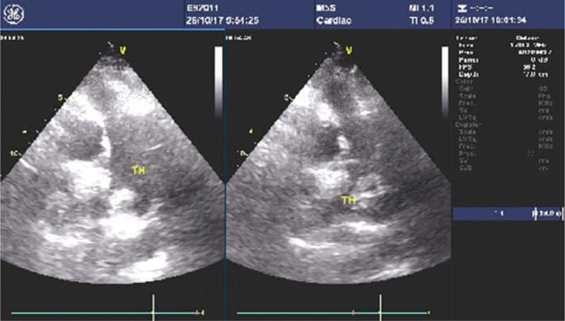 This diagnostic image consists of side-by-side grayscale transesophageal echocardiography (TEE) frames focused on the left heart structures. The primary finding is a large, well-defined echogenic mass labeled 'TH', representing a thrombus, situated within the left atrial appendage (LAA). The thrombus appears heterogeneous and slightly more hyperechoic than the surrounding myocardial tissue. The background shows characteristic echocardiographic features of an enlarged left atrium, consistent with clinical findings of dilated cardiomyopathy and atrial fibrillation. Metadata on the display indicates the image was acquired using a GE healthcare ultrasound system with a cardiac probe (M5S), noting mechanical index (MI) and thermal index (TI) parameters. This visual demonstrates a critical clinical complication of atrial fibrillation—thrombosis despite anticoagulant therapy—and highlights the role of TEE in screening prior to procedures like catheter ablation.