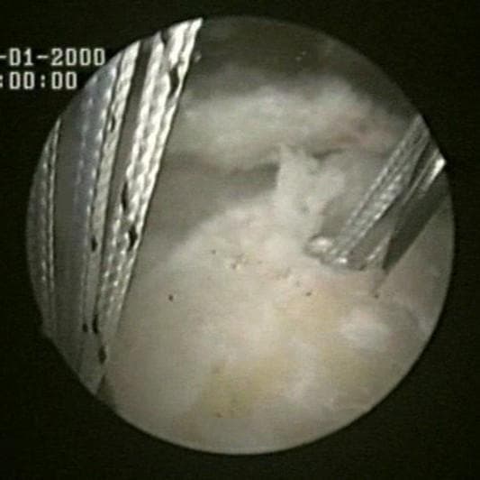 Arthroscopic clinical photograph of a shoulder rotator cuff repair procedure. The image depicts the medial row anchor placement lateral to the articular cartilage of the humeral head. Two Bio-Corkscrew suture anchors are visible, double-loaded with high-strength braided FiberWire sutures. The anchors are positioned in the anteromedial aspect of the footprint, fixed directly into the bone. Multiple strands of the sutures are shown extending from the anchor eyelets, appearing as parallel, braided lines against the light-colored, rounded humeral bone surface. Some soft tissue, likely representing the edge of the rotator cuff tendon, is visible adjacent to the surgical repair site. This image serves as a clinical reference for orthopedic surgical techniques, specifically demonstrating the foundational steps of a double-row or Roman Bridge construct for stabilizing tendon-to-bone interfaces in the shoulder.