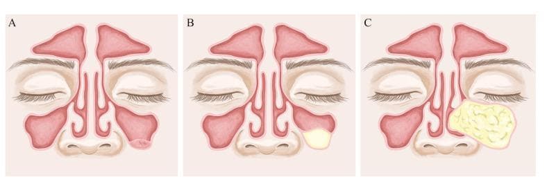 Anatomical diagram in a frontal (coronal) view of the midface, illustrating three distinct types of benign paranasal sinus lesions within the maxillary sinuses. All three panels (A, B, and C) display consistent anatomy, including the frontal sinuses, nasal cavity with turbinates and septum, and the maxillary sinuses. Panel A depicts a Pseudocyst, characterized by a small, dome-shaped, pinkish lesion originating from the floor of the left maxillary sinus. Panel B illustrates a Mucous Retention Cyst, shown as a smooth, pale-yellow, well-circumscribed mass located in the inferior aspect of the right maxillary sinus. Panel C demonstrates a Mucocele, represented as a significantly larger, yellowish, lobulated, and complex mass that occupies most of the right maxillary sinus, potentially exerting pressure on the sinus walls. This comparison focuses on the differential diagnosis of paranasal sinus opacifications, highlighting variations in morphology, size, and internal texture. The illustration is intended for educational use in otolaryngology and radiology to distinguish between fluid-filled cysts and more expansive sinus pathologies.