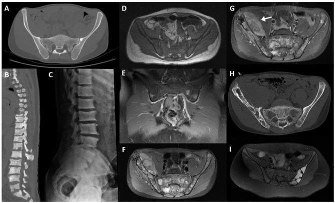 This composite figure presents various radiological modalities illustrating primary and secondary bone tumors affecting the spine and pelvis. (A) Axial CT shows an iliac bone enostosis (bone island). (B, C) Sagittal CT reconstruction and lateral radiograph demonstrate diffuse osteoblastic metastases in the lumbar spine, characterized by multifocal vertebral sclerosis typical of metastatic prostate cancer. (D) Axial T1-weighted MRI and (E) coronal post-contrast fat-saturated T1-weighted MRI reveal leukemic infiltration of the sacrum and iliac bones, evidenced by diffuse T1 hypointensity and patchy contrast enhancement indicating bone marrow replacement. (F-H) Axial PD fat-saturated MRI, post-contrast T1-weighted MRI, and axial CT depict a large Ewing sarcoma of the right iliac bone with a significant soft tissue component (arrow) and aggressive cortical destruction. (I) Axial fat-saturated PD MRI shows an aneurysmal bone cyst of the left iliac bone, characterized by multi-loculated fluid-fluid levels. The collection serves to educate on distinguishing benign variants like enostosis from aggressive primary malignancies and systemic marrow infiltrative processes.