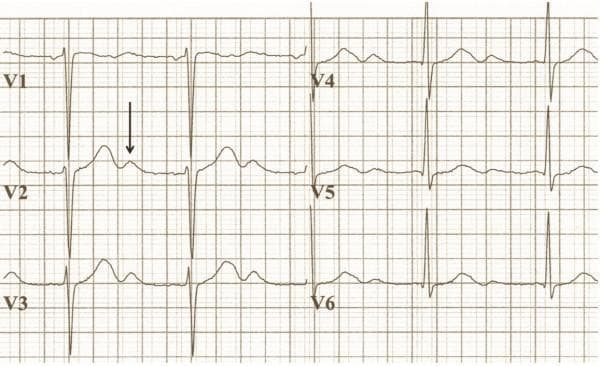 This diagnostic image is a 6-lead electrocardiogram (ECG) trace focusing on the precordial leads (V1-V6). The tracing demonstrates classic features associated with hypokalemia, specifically in a clinical context of a 2.7 mM/l potassium level. In leads V1, V2, and V3, there is visible ST-segment depression and a reduction in T-wave amplitude. A prominent, marked U-wave is indicated by a black arrow in lead V2, following the T-wave. The right precordial leads (V4-V6) show tall R-waves with high voltage, meeting the voltage criteria for left ventricular hypertrophy (LVH). The combination of high-amplitude QRS complexes and the characteristic repolarization abnormalities (U-waves, ST depression, and flattened T-waves) provides a key educational example of how electrolyte imbalances and structural heart changes manifest on a standard ECG. This is an intermediate-level resource for cardiology and internal medicine training, illustrating the diagnostic findings of severe hypokalemia and hypertensive heart disease morphology.