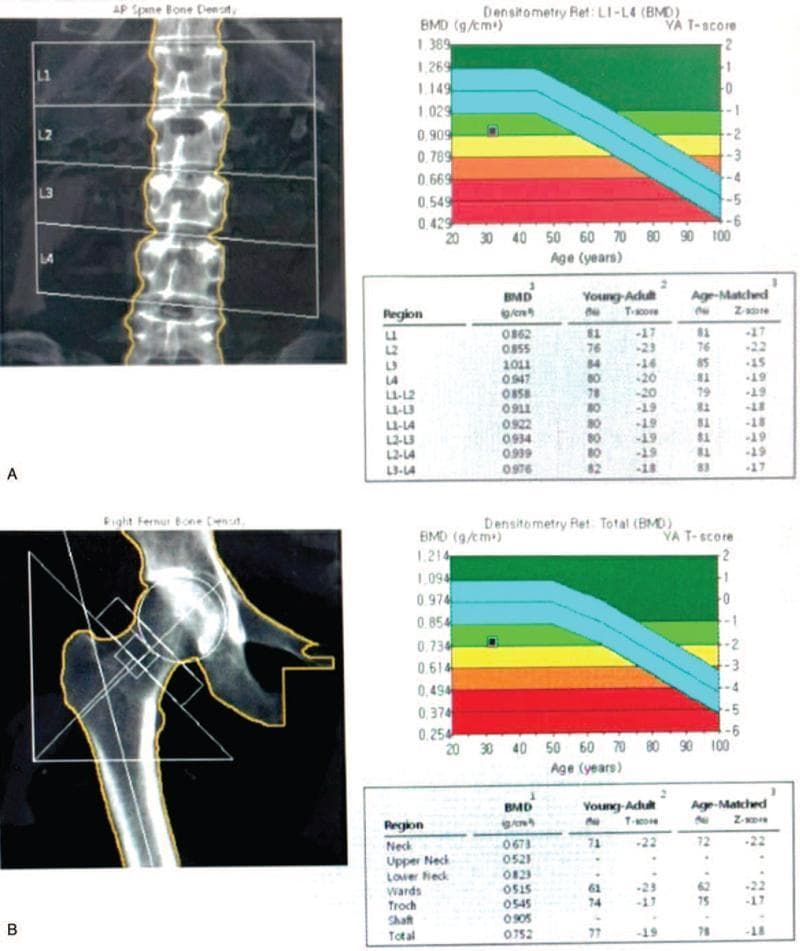 This diagnostic visual presents the results of a Dual-Energy X-ray Absorptiometry (DEXA) scan used for assessing bone mineral density (BMD) in the lumbar spine and femur. Section A depicts the Anteroposterior (AP) spine bone density for L1–L4, showing segmented vertebrae with corresponding BMD measurements (g/cm²), T-scores, and Z-scores in a tabular format. A reference graph plots the patient’s BMD against age-matched norms, using color-coded zones to categorize bone health (e.g., green for normal, yellow for osteopenia, and red for osteoporosis). Section B shows a similar analysis for the right proximal femur, highlighting the femoral neck, Ward’s triangle, and trochanter. Overlaid geometric regions on the femoral radiograph indicate the specific areas of interest for measurement. This content serves as a clinical assessment tool in endocrinology and orthopedics for diagnosing conditions like osteoporosis or monitoring treatment response in patients with metabolic bone disease.