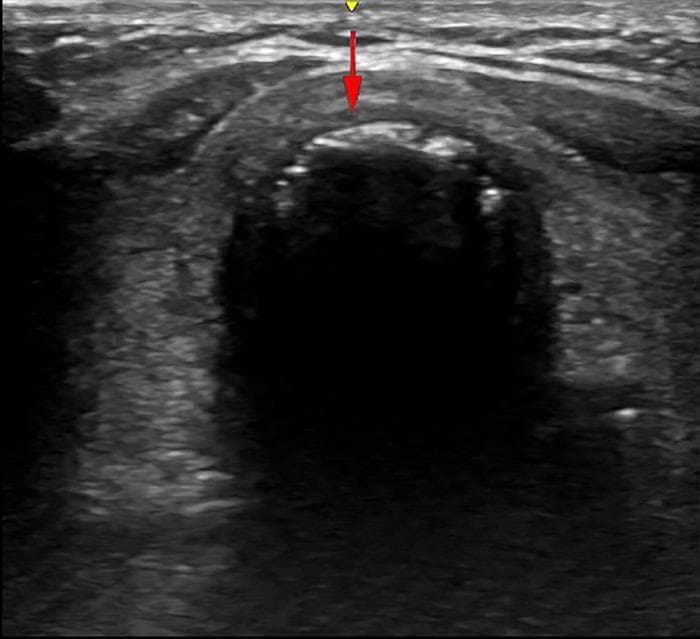 This diagnostic ultrasound image demonstrates a cross-sectional view of the anterior neck, specifically focusing on the tracheal anatomy for procedural guidance. The trachea is identified by its characteristic hyperechoic, curved cartilaginous rings with posterior acoustic shadowing. The visual focus is on the inter-annular space between the second and third tracheal rings, which appears as a relatively hypoechoic region between the bright cartilaginous interfaces. Two annotation markers are present: a yellow arrow at the superior aspect indicates the position and orientation of the ultrasound probe on the skin surface, and a red arrow indicates the vertical trajectory for a puncture needle. This imaging is used in the clinical context of percutaneous dilatational tracheostomy (PDT) to ensure accurate needle insertion into the tracheal lumen while avoiding vascular structures or the thyroid isthmus. The dark, anechoic region deep to the anterior tracheal wall represents the air-filled tracheal lumen, which creates a significant interface blocking deeper visualization.