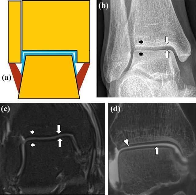 This composite educational image illustrates the normal anatomy and multimodal imaging appearances of the talocrural (ankle) joint. Panel (a) is a schematic diagram showing the articulation of the distal tibia and fibula with the talus, highlighting the articular cartilage (blue), cortical bone (black), bone marrow (yellow), and ligaments (brown). Panel (b) presents a conventional mortise view radiograph, demonstrating smooth articular surfaces (arrows) and normal trabecular bone patterns (stars). Panel (c) is a coronal MRI (Proton Density fat-suppressed) showing the cartilage as a thin layer of intermediate signal intensity (arrows) and homogenous marrow signal (stars). Panel (d) displays a Cone Beam CT (CBCT) arthrography reformatted image, where intra-articular contrast provides superior visualization of the cartilage lining on the talar dome (arrow) and distal tibia (arrowhead) compared to routine MRI. The set serves as a comparative reference for diagnosing osteochondral lesions, emphasizing how different modalities delineate the interface between subchondral bone and articular cartilage.