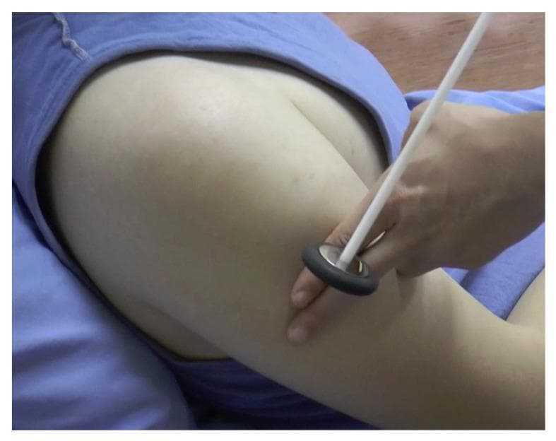 This clinical procedural photograph demonstrates the technique for eliciting a deep tendon reflex in the upper extremity, specifically targeting the deltoid tendon. A healthcare provider is shown using a Babinski-style reflex hammer, characterized by a slender, light-colored handle and a circular, disk-shaped head with a dark rubberized peripheral ring. The examiner's hand holds the handle between the thumb and fingers to provide a controlled, swinging motion. The patient is positioned supine, with the shoulder and upper arm exposed. The reflex hammer's head is shown at the point of impact on the lateral aspect of the upper arm, near the insertion of the deltoid muscle. This procedure is fundamental in a neurological examination to assess the integrity of the C5 and C6 spinal nerve roots and the axillary nerve. The image serves as an educational tool for medical students and clinicians to visualize proper tool handling and anatomical targeting for upper limb reflex testing.