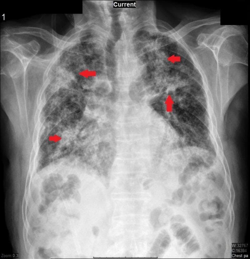 This diagnostic image is a posterior-anterior (PA) chest radiograph illustrating significant pulmonary pathology. The radiograph demonstrates diffuse, bilateral increased reticular markings and patchy opacities consistent with multi-lobular consolidation. Red arrows highlight specific areas of denser consolidation in the upper and middle lung zones. The lung parenchyma shows a mix of interstitial thickening and alveolar filling, which clinically correlates with infectious or inflammatory processes such as community-acquired pneumonia or an exacerbation of underlying interstitial lung disease (ILD). Key anatomical landmarks including the clavicles, ribs, and mediastinal silhouette are visible, though the diaphragmatic borders are partially obscured by the extensive pulmonary opacification. The image is a primary educational resource for recognizing the radiological presentation of multi-lobar pneumonia and diffuse lung disease in a clinical setting.