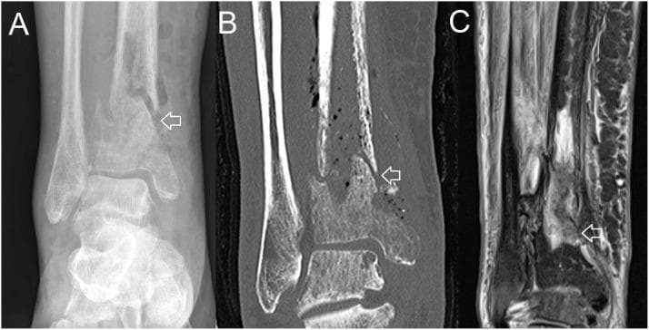 This composite clinical image displays a pathological fracture of the distal tibia through three imaging modalities: (A) plain X-ray, (B) Computed Tomography (CT), and (C) Magnetic Resonance Imaging (MRI). The plain X-ray shows a radiolucent fracture line and periosteal reaction in the distal tibial shaft above the ankle joint. The coronal CT scan provides superior bony detail, revealing cortical disruption, sequestration, and small gas bubbles within the medullary cavity and surrounding soft tissue, highly suggestive of chronic osteomyelitis with secondary fracture. The MRI (STIR or T2-weighted sequence) highlights the extent of the inflammatory process, showing hyperintense signals indicative of significant marrow edema and soft tissue phlegmon or abscess formation. This comparison demonstrates the multi-modal diagnostic approach to bone and joint infections (BJI), illustrating how CT excels at identifying structural bone destruction while MRI is most sensitive for detecting early inflammatory changes and soft tissue involvement. The location and appearance are characteristic of a complication resulting from severe osteomyelitis.