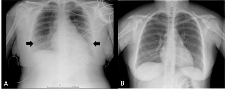 This comparison chart consists of two anteroposterior chest X-ray (CXR) images illustrating the progression and resolution of acute pulmonary edema. Image A, labeled as a postpartum clinical photograph from the postanesthesia care unit (PACU), demonstrates a significant bilateral pathology characterized by diffuse pulmonary infiltrates and marked hilar engorgement, indicated by black arrows. The cardiac silhouette appears widened, and peribronchial cuffing is suggestive of interstitial fluid accumulation. Monitoring leads and a central line are visible, indicating an acute clinical setting. In contrast, Image B shows the same patient five days later, following diuretic therapy. This follow-up radiograph reveals a complete resolution of the previous abnormalities; the lung fields are clear, the costophrenic angles are sharp, the hilar regions have returned to normal size, and the bronchovascular markings are within normal limits. The pair serves as a diagnostic comparison for identifying acute pulmonary congestion and its resolution over time in an obstetric or postoperative context.