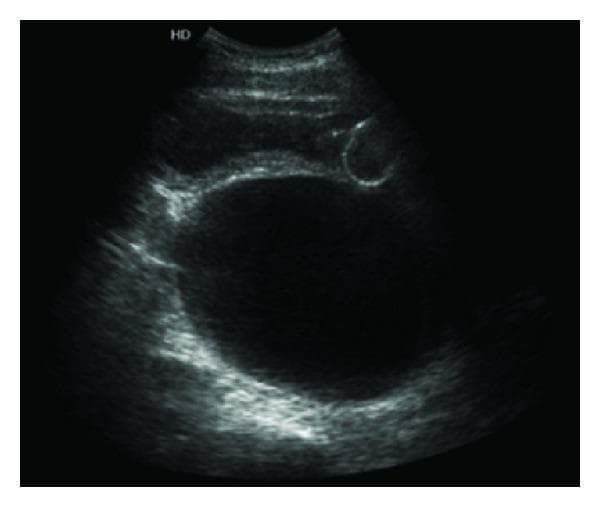 An abdominal ultrasound image in the transverse plane demonstrating a large, predominantly anechoic (dark), well-circumscribed cystic lesion located in the retrovesical space. The cyst exhibits a thin, regular wall without visible internal septations, solid components, or debris, suggesting a simple fluid-filled nature. Anteriorly, the urinary bladder is visible and appears compressed by the extrinsic mass effect of the cyst. The lesion is documented to have an approximate volume of 780 cc. The surrounding pelvic tissues show heterogeneous echogenicity, and the presence of acoustic enhancement posterior to the cyst is characteristic of a fluid-filled structure. This clinical finding is associated with bilateral obstructive uropathy and bladder outlet obstruction symptoms. The image is an essential diagnostic example for identifying retroperitoneal masses and pelvic cystic lesions, such as a periureteral diverticulum, within a urological context.