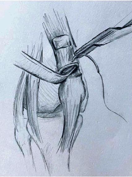 This medical illustration depicts a surgical technique for quadriceps tendon reconstruction using a synthetic mesh graft. The drawing shows the knee joint anatomy including the patella, patellar tendon, and the remnant of the quadriceps tendon. A tubularized mesh, such as a polypropylene mesh, is seen being secured to the proximal quadriceps tendon stump. A surgical needle holder or forceps is shown in the superior-right field, applying a running suture—specifically a Krackow suture technique—to achieve intrasubstance fixation. The mesh is integrated into a longitudinal tunnel within the tendon, providing a scaffold for repair in cases of chronic or recurrent rupture. The illustration focuses on the proximal fixation stage, emphasizing the mechanical anchoring of the graft to the native soft tissue to restore the extensor mechanism of the knee. This pedagogical diagram is intended for orthopaedic surgical education, demonstrating salvage procedures for complex tendon repairs.