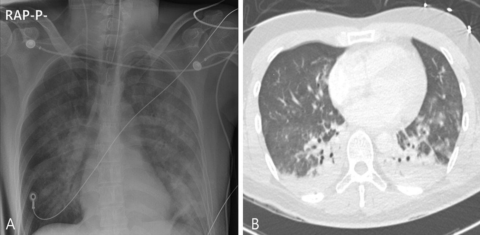 This composite diagnostic image displays acute pulmonary pathology through two imaging modalities. Image A is an anteroposterior chest X-ray demonstrating diffuse, bilateral pulmonary infiltrates and increased opacification throughout both lung fields, consistent with severe parenchymal lung disease or acute respiratory distress syndrome (ARDS). Medical support devices, including ECG leads and an endotracheal tube, are visible. Image B is an axial non-contrast chest CT scan (lung window) showing a distinct anterior-posterior density gradient. The dependent (posterior) regions of the lungs exhibit dense consolidation and atelectasis, while the non-dependent (anterior) regions show diffuse ground-glass opacities. Small bilateral pleural effusions are also suggested. The findings are characteristic of the early exudative phase of ARDS or severe inhalation injury, where fluid and inflammatory debris accumulate in the most dependent portions of the lungs.