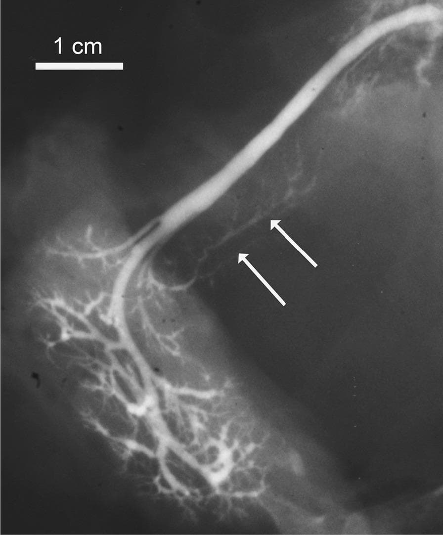 This diagnostic sialogram captures the ductal anatomy of a submandibular gland. The image features a prominent, radiopaque main submandibular duct (Wharton's duct) characterized by a thick, curvilinear morphology. Distally, the duct branches into an intricate, dendritic network of smaller intraglandular ducts that decrease in caliber as they penetrate the glandular parenchyma. Two white arrows indicate an accessory salivary lobe, visible as a cluster of small, rounded contrast-filled structures joining the lateral aspect of the main duct. This accessory tissue exhibits slightly lower contrast intensity compared to the primary duct. A 1 cm scale bar is provided in the upper left corner for morphometric reference. This image is used in clinical education to demonstrate normal anatomical variations, specifically the presence of accessory submandibular lobes, and to illustrate standard salivary ductal architecture.
