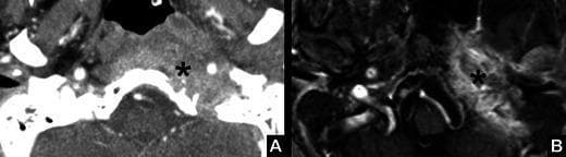 This dual-modality clinical imaging set illustrates skull base osteomyelitis in a 74-year-old male. Image A is an axial contrast-enhanced CT scan demonstrating a destructive mass (marked by an asterisk) at the level of the left skull base. The lesion is characterized by ill-defined, irregular margins and increased density, indicating infiltration between the petrous apex and the temporomandibular joint with associated bone destruction. Image B is a T1-weighted contrast-enhanced MRI with fat saturation at the same anatomical level. The corresponding area (asterisk) shows intense, irregular enhancement, highlighting active inflammation or infection and soft tissue infiltration. The pathological process involves the left jugular foramen, providing a clinical explanation for associated cranial nerve deficits such as hypoglossal nerve palsy and vocal cord paralysis (VCP). This case emphasizes the diagnostic features of aggressive skull base infections, including the loss of normal anatomical fat planes, cortical erosions on CT, and avid enhancement on fat-suppressed MRI sequences.