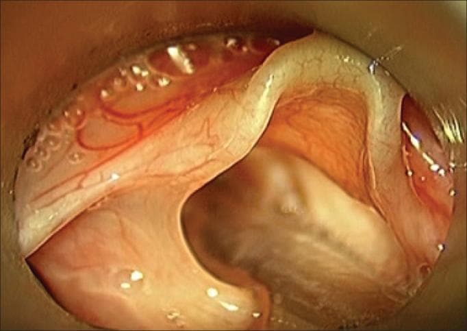 This diagnostic image is an intraoperative endoscopic view of the pediatric larynx during suspension microlaryngoscopy. The clinical photograph demonstrates the hallmark features of laryngomalacia in a 3-month-old infant. The primary finding is the significant shortening and thickening of the aryepiglottic folds, which appear pale, redundant, and edematous. These foreshortened folds contribute to the inward collapse of the supraglottic structures, partially obscuring the laryngeal inlet. The mucosal surface shows a moderate degree of vascularity with fine, branching subepithelial vessels and small, clear fluid-filled vesicles consistent with localized edema or chronic inflammation. Specular reflections from the moist mucosal surface are visible under the endoscopic light source. The educational focus of the image is the anatomical malformation of the supraglottic tissues that leads to inspiratory stridor in pediatric patients, illustrating the surgical landmarks required for supraglottoplasty.