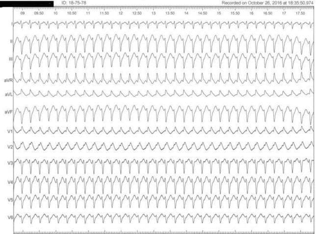 This diagnostic image shows a standard 12-lead surface electrocardiogram (ECG) recorded during a clinical episode of palpitations. The tracing displays a regular, narrow-complex supraventricular tachycardia (SVT). The rhythm is characterized by a rapid heart rate with consistent R-R intervals across all leads (I, II, III, aVR, aVL, aVF, and V1–V6). In the precordial leads V3–V6, the QRS complexes exhibit sharp peaks, while the limb leads (I, II, III, aVR, aVL, aVF) demonstrate relatively broader morphologies with steep ascents and descents. Leads V1 and V2 show lower voltage amplitude compared to the lateral leads. P-waves are not clearly discernible before each QRS complex, suggesting a tachyarrhythmia such as Atrioventricular Nodal Reentrant Tachycardia (AVNRT), which was later confirmed via electrophysiology study (EPS). The horizontal axis includes time markers from 09.00 to 17.50 seconds, indicating a stable morphology throughout the recording period. This ECG is a key educational tool for identifying supraventricular tachycardias in patients with structurally normal hearts complaining of paroxysmal palpitations.