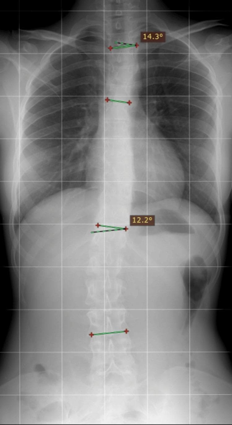 This diagnostic image is a posteroanterior (PA) plain film radiograph of the torso, specifically formatted for scoliosis monitoring. The X-ray demonstrates the thoracolumbar spine and ribcage with digital overlays used for measurement. The visual features show a mild S-shaped lateral curvature of the vertebral column, characteristic of adolescent idiopathic scoliosis. Digital annotations indicate two primary curvatures: a sinistro-convex (left-leaning) thoracic curve with a measured Cobb angle of 14.3 degrees and a dextro-convex (right-leaning) lumbar curve with a measured Cobb angle of 12.2 degrees. The ribcage shows preserved costal integrity without acute displaced fractures in this view. The image is overlayed with a grid pattern to assist in assessing spinal alignment and vertical deviation. This radiographic study is essential for monitoring the progression of spinal deformities in orthopedic and physical medicine contexts, allowing clinicians to track changes in curvature severity over time.