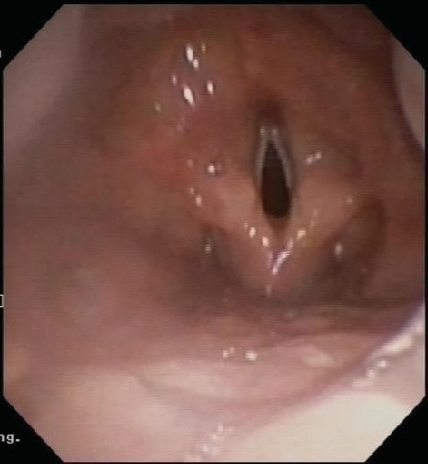 This clinical image is a fiberoptic endoscopic view of the laryngeal introitus. The most striking pathological finding is the complete absence of the epiglottis, a condition known as epiglottic aplasia or agenesis. Normally, the epiglottis appears as a cartilaginous, flap-like structure anterior to the glottis; here, the region where the epiglottis should be located is characterized by a smooth, continuous mucosal surface without any distinct projection. Centrally, the vocal folds (true vocal cords) are visible and appear structurally intact with a clear glottic opening. The surrounding supraglottic tissues, including the arytenoids and aryepiglottic folds, show a moist, pink mucosal lining typical of laryngeal anatomy, though the normal contours are altered by the lack of epiglottic support. Small white specular reflections from the endoscopic light source are visible on the mucosal surface. This rare congenital anomaly has significant clinical relevance regarding airway protection and swallowing mechanics.
