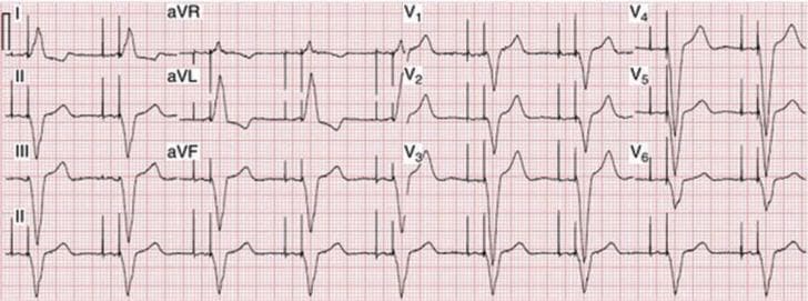 This diagnostic image is a standard 12-lead electrocardiogram (ECG) printed on grid paper, demonstrating dual-chamber (DDD) cardiac pacing. The layout includes limb leads (I, II, III, aVR, aVL, aVF) and precordial leads (V1-V6) arranged in a multi-channel format, with a rhythm strip of Lead II at the bottom. The tracing clearly shows distinct vertical pacemaker spikes occurring in a sequential manner. The first spike (atrial spike) precedes the P-wave, followed by a second spike (ventricular spike) immediately preceding the QRS complex, indicating an AV-sequential pacing mode. The QRS complexes exhibit a widened morphology with a left bundle branch block-like pattern, particularly visible in the precordial leads, which is characteristic of right ventricular apical pacing. This ECG serves as an educational example for identifying artificial pacemaker activity, understanding dual-chamber pacing logic, and recognizing the morphology of paced cardiac rhythms in clinical practice.