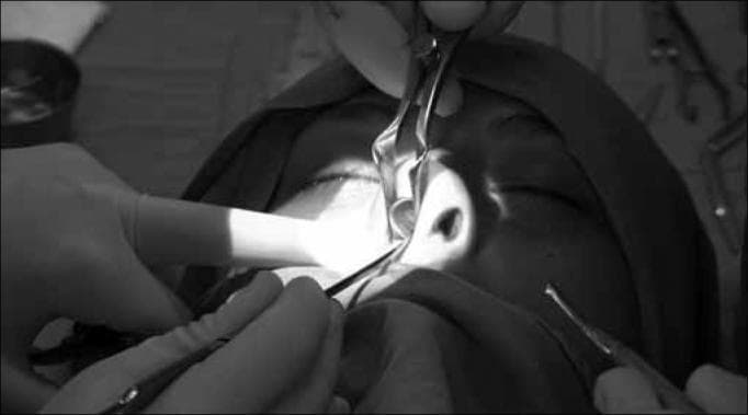 This monochrome clinical photograph captures an intraoperative view of a nasal septoplasty or rhinoplasty procedure. The surgical field focuses on the endonasal cavity under bright focal illumination. A Killian or Cottle nasal speculum is being used to retract the nasal alae and provide visualization of the internal nasal structures. A secondary surgical instrument, likely a periosteal elevator or suction-lifter, is positioned to manipulate the nasal septum. The image illustrates the resection of an anterior deviated portion of the septal cartilage while maintaining the structural integrity of the supratip and nasal dorsum regions to prevent postoperative saddle nose deformity. The surrounding area shows sterile draping and gloved hands, characteristic of an Otolaryngology (ENT) operative setting. This visual serves as an educational tool for understanding conservative septal resection techniques and the preservation of dorsal support during reconstructive nasal surgery.