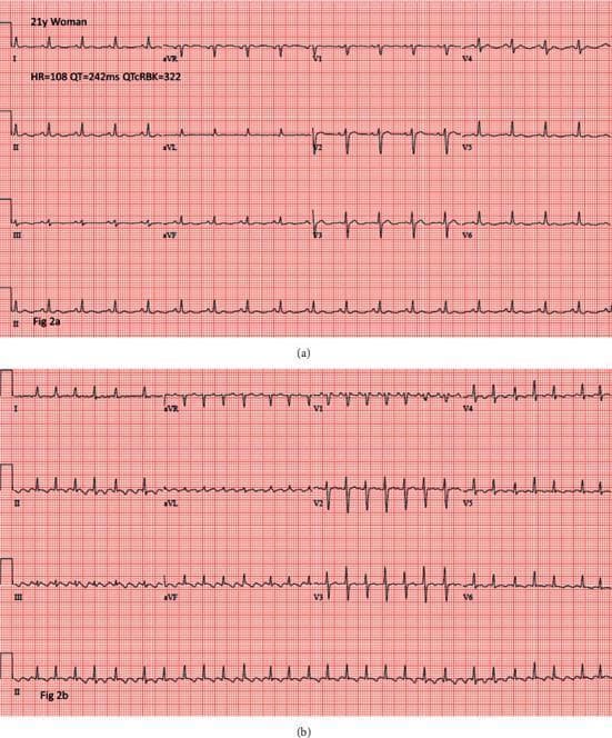 Two-part comparison of a 12-lead electrocardiogram (ECG) from a 21-year-old female patient, illustrating the progression from short QT syndrome to atrial flutter. Panel (a) shows a baseline rhythm at 108 bpm with a notably short QT interval of 242 ms (QTcRBK = 322 ms). The rhythm is sinus, characterized by upright P waves in leads I, II, and aVF, and a normal QRS morphology. Panel (b) displays a subsequent ECG demonstrating the development of an irregular rhythm. Distinct P waves are absent and replaced by organized 'sawtooth' atrial flutter waves, most prominent in the inferior leads (II, III, aVF). The QRS complexes remain narrow but exhibit variable R-R intervals, consistent with atrial flutter and variable atrioventricular (AV) conduction. This comparison serves as an educational illustration of the increased risk for supraventricular tachyarrhythmias, such as atrial flutter and fibrillation, in patients with congenital or acquired short QT intervals.