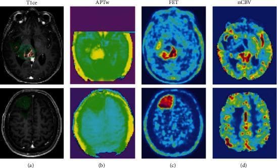 This diagnostic comparison chart displays multi-modal brain imaging for a high-grade glioblastoma (upper row) and a low-grade glioma (lower row) across four modalities: contrast-enhanced T1-weighted MRI (T1ce), amide proton transfer-weighted (APTw) MRI, FET PET, and normalized cerebral blood volume (nCBV) maps. Column (a) shows T1ce MRI with segmentation overlays: red indicates contrast-enhancing tumor (CET) and green highlights FLAIR hyperintense tumor (FHT). In the glioblastoma, CET and FHT are more extensive and irregular compared to the circumscribed regions in the low-grade glioma. Column (b) presents APTw imaging, where the glioblastoma exhibits higher yellow-green signal intensity, signifying increased endogenous protein/cellularity. Column (c) FET PET images demonstrate significantly higher amino acid uptake (red hot spots) in the glioblastoma, indicating higher metabolic activity. Column (d) nCBV maps show increased perfusion (red/yellow areas) in the glioblastoma, reflecting higher vascularity. This comparison highlights how multi-parametric advanced imaging differentiates tumor grades based on cellularity, metabolism, and hemodynamics.