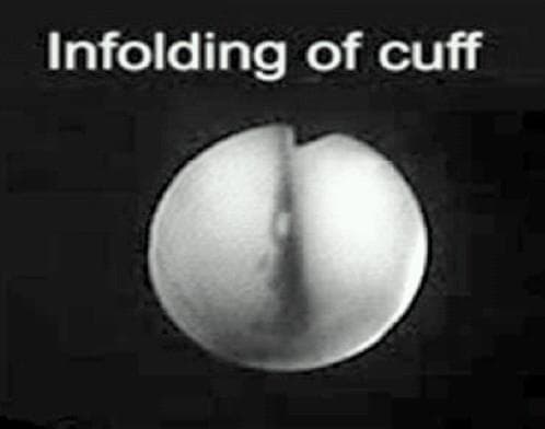 This endoscopic or clinical image illustrates a specific malposition of a laryngeal mask airway (LMA) known as cuff infolding. The visual demonstrates an inflated cuff that has lost its normal elliptical shape; the lateral margins of the cuff have rotated inward toward the center. This inward rotation causes the two sides of the cuff to meet and contact at the midline, creating a prominent vertical groove or division that bisects the structure. This configuration effectively obliterates the central bowl area, which is intended to facilitate gas flow into the laryngeal inlet. Such malposition typically occurs during insertion or as a result of pre-insertion over-inflation, leading to mechanical airway obstruction. The image is an essential educational resource for anesthesiologists and airway management specialists to recognize the visual signs of improper LMA placement and distinguish it from other complications like epiglottic downfolding.
