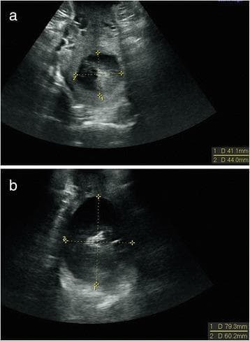 Diagnostic transperineal ultrasound images illustrating 2D measurements of cervical dilatation during labor in a transverse view. The figure contains two panels, labeled (a) and (b), representing different stages of labor progression. In panel (a), electronic calipers (D1 and D2) measure the anterior-posterior and transverse diameters of the cervical os, recording values of approximately 41.1 mm and 44.0 mm, indicating a mid-stage cervical dilatation of roughly 4.3 cm. In panel (b), the cervical opening is significantly more advanced, with measurements of 79.3 mm and 60.2 mm, corresponding to a dilatation of approximately 7.0 cm. The ultrasound captures the hypoechoic area of the dilated cervix against the surrounding soft tissue. This educational material demonstrates the use of objective ultrasound assessment as a non-invasive alternative or supplement to digital cervical examination for monitoring labor progress and cephalic presentation.
