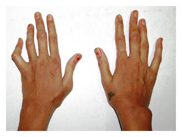 Clinical photograph of the dorsal aspect of bilateral hands and wrists in a patient with Rheumatoid Arthritis (RA). The image demonstrates characteristic chronic inflammatory joint deformities. On the left hand, there is a prominent swan-neck deformity of the fifth digit, characterized by hyperextension of the proximal interphalangeal (PIP) joint and flexion of the distal interphalangeal (DIP) joint. Swelling is visible across the interphalangeal joints of the third and fourth digits. The right hand shows a significant, localized soft tissue swelling on the lateral/ulnar aspect of the wrist joint, consistent with synovial hypertrophy or a rheumatoid nodule. General architectural changes include joint stiffness and minor deviations of the fingers. This visual illustrates the progressive peripheral joint involvement and resulting anatomical deformities typical of systemic inflammatory polyarthritis, emphasizing the clinical signs used in diagnosing the severity of RA.