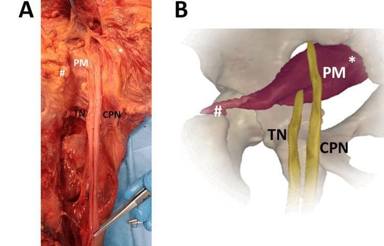 This composite educational image illustrates an anatomical variation of the sciatic nerve (SN) in relation to the piriformis muscle (PM). Panel A is a clinical photograph of a cadaveric dissection of the gluteal region, and Panel B is a 3D anatomical diagram representing the same variation. The visual content demonstrates a high division of the sciatic nerve into its two primary branches: the tibial nerve (TN) and the common peroneal nerve (CPN). In this specific variation, the CPN passes superior to the piriformis muscle, while the TN passes deep to or through the muscle belly. Labels indicate the proximal origin (*) and distal insertion (#) of the piriformis muscle. This anatomical comparison highlights variations relevant to clinical scenarios such as piriformis syndrome, nerve entrapment, and surgical planning for the posterior approach to the hip. The material is intended for advanced anatomy students and surgical residents to understand peripheral nerve morphology and potential sites of neurovascular compression.