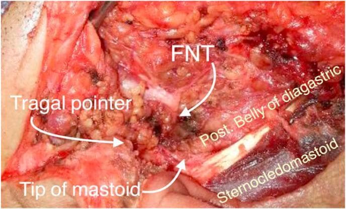 This clinical photograph shows an intraoperative surgical field during a parotidectomy, focusing on the identification of the facial nerve trunk (FNT). The image illustrates key anatomical landmarks used to localize the nerve as it exits the stylomastoid foramen. The FNT is centrally located and annotated in the dissection field. Superior to the nerve is the 'Tragal pointer', a cartilaginous landmark. Inferior and slightly posterior to the FNT is the 'Tip of mastoid' process. Additional visible muscular landmarks include the posterior belly of the digastric muscle, which lies deep and inferior to the nerve trunk, and the sternocleidomastoid muscle, visible at the inferior-most aspect of the surgical site. The photograph demonstrates the spatial relationship between these soft tissue and bony structures, which serve as essential surgical guides for preventing iatrogenic facial nerve injury during head and neck surgery. The educational focus is on the surgical anatomy of the parotid region and the safe identification of the extra-temporal facial nerve.